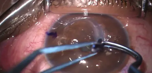 Corneal Allogenic Intrastromal Ring Segment