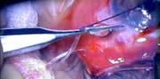 Pearls for Safer Tube Surgery