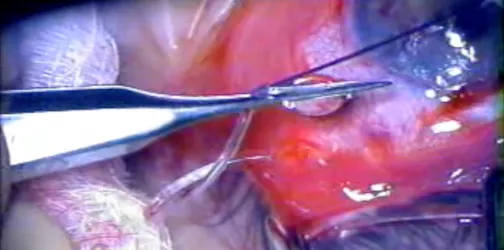 Pearls for Safer Tube Surgery