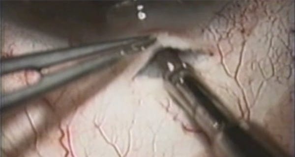 Safety-Valve Trabeculectomy to Avoid Hypotony and Repair of Hypotony Maculopathy thumbnail