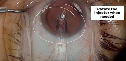 EVO ICL Insertions - Eyetube