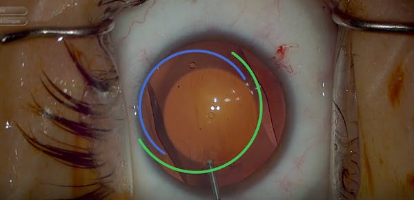 Avoid IOP Spikes With the EVO ICL (OVD Evacuation Tips) thumbnail