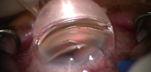 iTrack Approach and Blanching