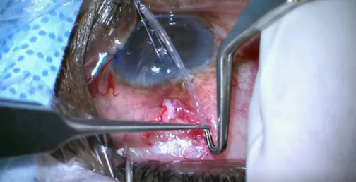 Herndon Tube Stretch Forceps