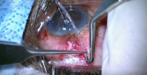 Herndon Tube Stretch Forceps thumbnail