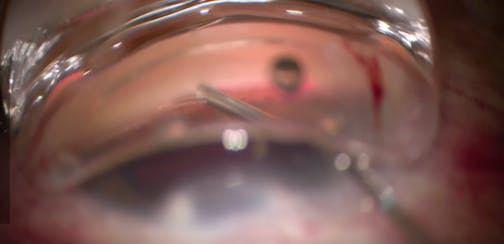 Combination Canaloplasty With Stenting