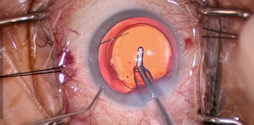 Combination Hydrus and Light Adjustable Lens