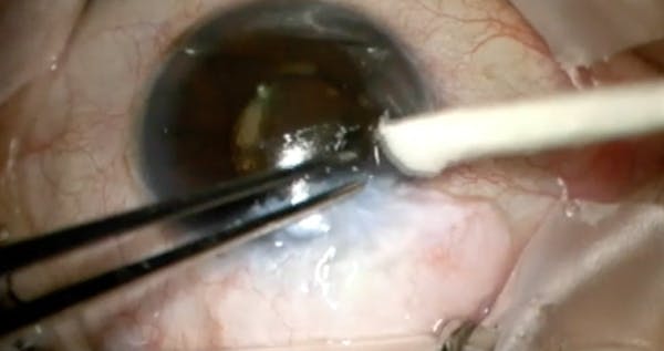 Trabeculectomy Bleb revision thumbnail