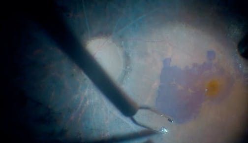 Complex Membrane Peeling for Vitreomacular Traction in Retinitis Pigmentosa