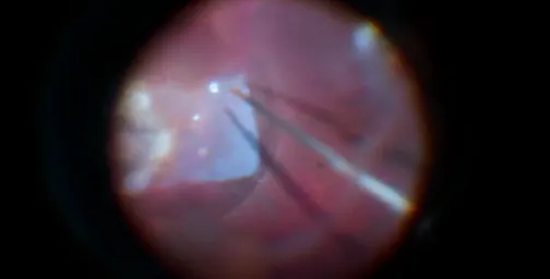Addressing a Refractory Macular Hole With an Amniotic Membrane Graft and PFO