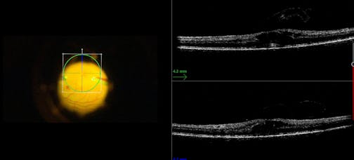 Irvine-Gass Syndrome
