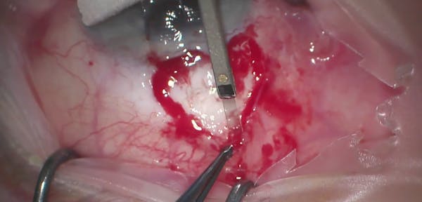 Excise and Mobilize: A Bleb Revision Technique thumbnail
