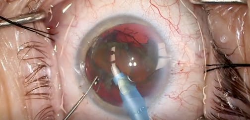 miCOR: Flip and Chip Technique