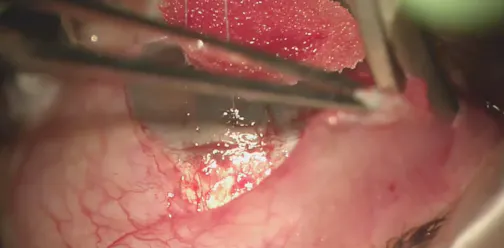 Complex Bleb Revision Simplified