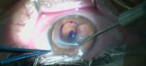 From Blurred to Brilliant: Overcoming Severe Keratoconus With CTAK