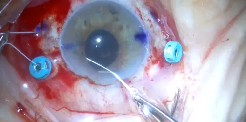 Scleral Fixation of an IOL With Gore-Tex