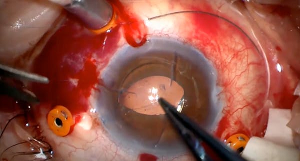 Iris Fixation of an IOL With McCannel Sutures thumbnail