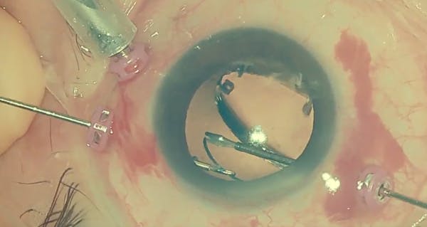 Modified Yamane for Dislocated Three-Piece PMMA IOL thumbnail
