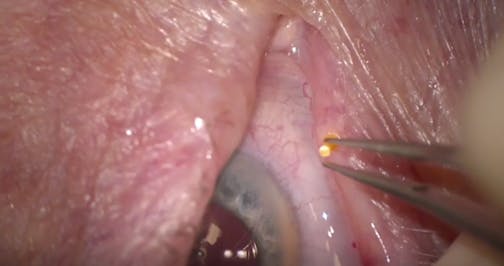 Dextenza: Upper Lid Insertion