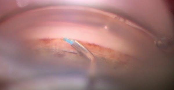 Ideal Trabecular Meshwork Approach for the OMNI Surgical System thumbnail