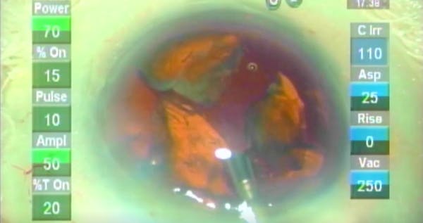 Understanding the Dropped Nucleus thumbnail