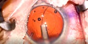 History of the Loose Cataract