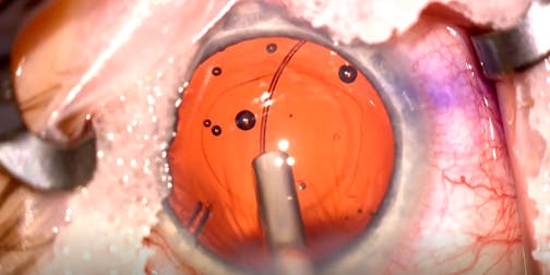 History of the Loose Cataract