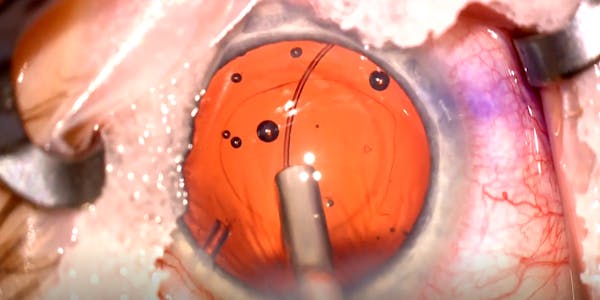 History of the Loose Cataract thumbnail
