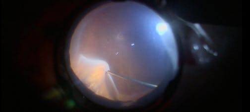 Triple Procedure for a Total Retinal Detachment