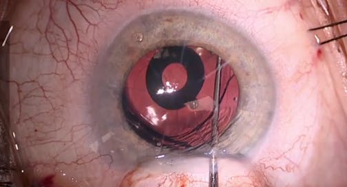 Apthera in an RK Patient