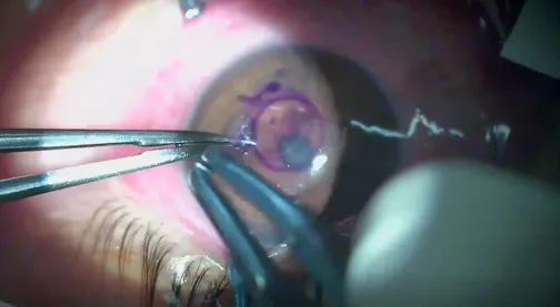 A New Approach to Keratoconus Treatment With CTAK and ICL