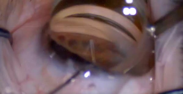 Rethinking Goniosynechialysis thumbnail