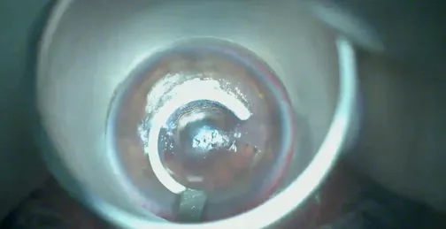 CTAK in a Post-LASIK Keratoconus Case: Surgical Challenges and Solutions