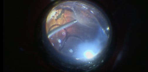 Drainage Retinotomy for a Retinal Detachment