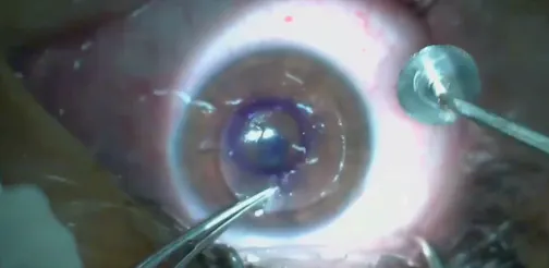 The Power of CTAK: Significantly Improving Vision for Mild Keratoconus