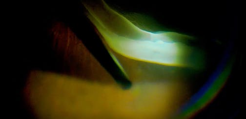 Vitrectomy for the Management of a Giant Retinal Tear
