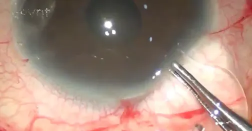 Hooked IOL Approach