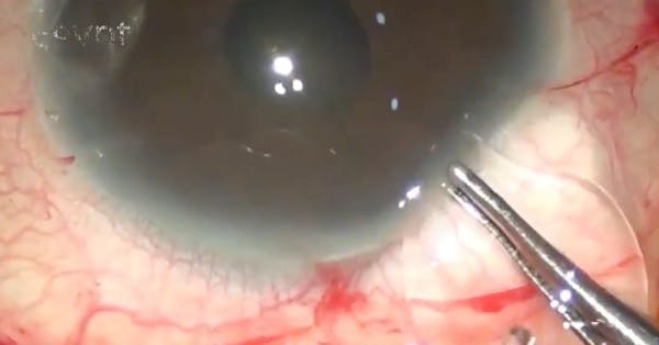 Hooked IOL Approach thumbnail
