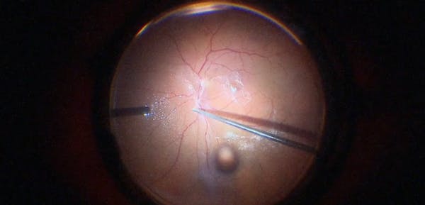 Severe Vitreoretinal Tractions and Retinal Detachment thumbnail