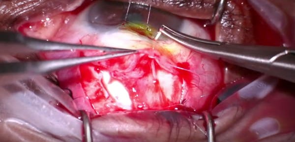 Sandwich Bleb Repair Technique thumbnail