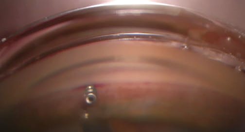 Interventional Glaucoma With iDose