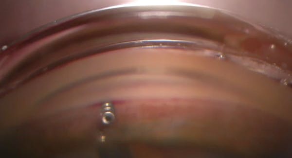 Interventional Glaucoma With iDose thumbnail