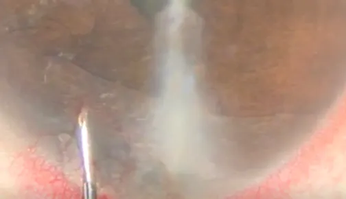 Management of an Iris Cyst