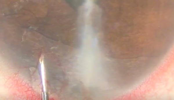 Management of an Iris Cyst thumbnail