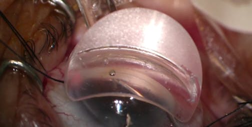 iTrack Canaloplasty: Moving Past the Blockage