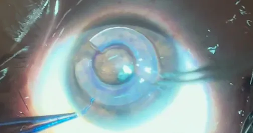 Restoring Functional Vision in Severe Keratoconus Using Corneal Tissue Addition Keratoplasty