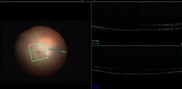 Vitreous Hemorrhage in a Phakic Eye thumbnail