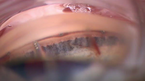 Interventional Glaucoma: iStent Infinite and iDose thumbnail