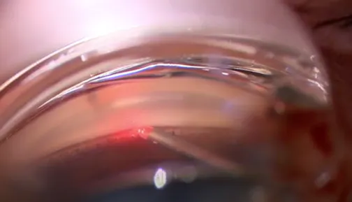 Pearls for Engaging TM With iTrack Advance