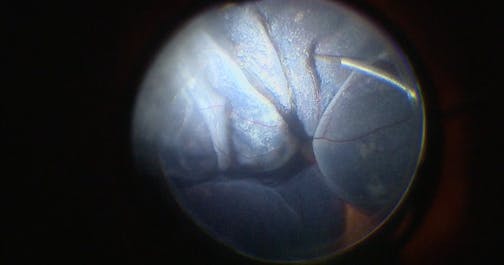Hemorrhagic Macular Degeneration-Related Retinal Detachment